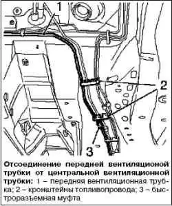 Замена передней вентиляционной трубки