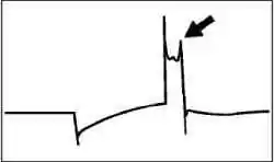 Примеры осцилограмм высокого напряжения неисправной системы зажигания